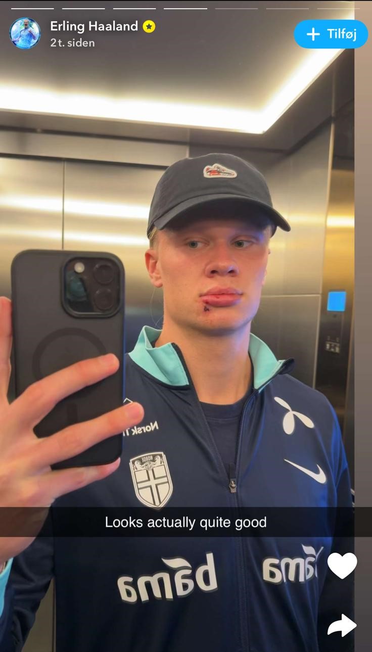 Erling Haaland-selfie fremviser sår i ansigtet.