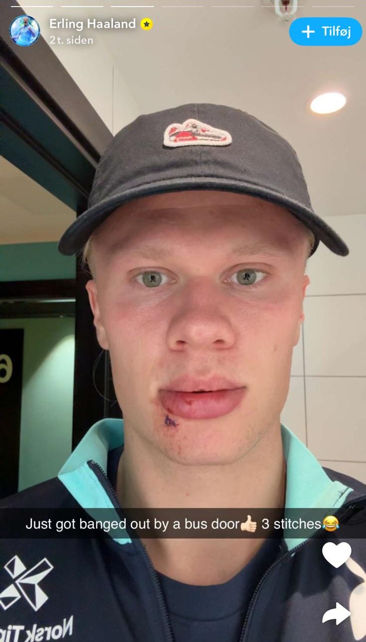 Erling Haaland fremviser sit sår under læben efter karambolage med busdør.